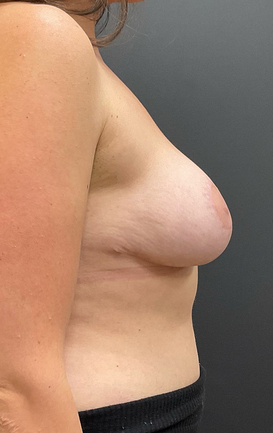 Breast Reduction Before & After