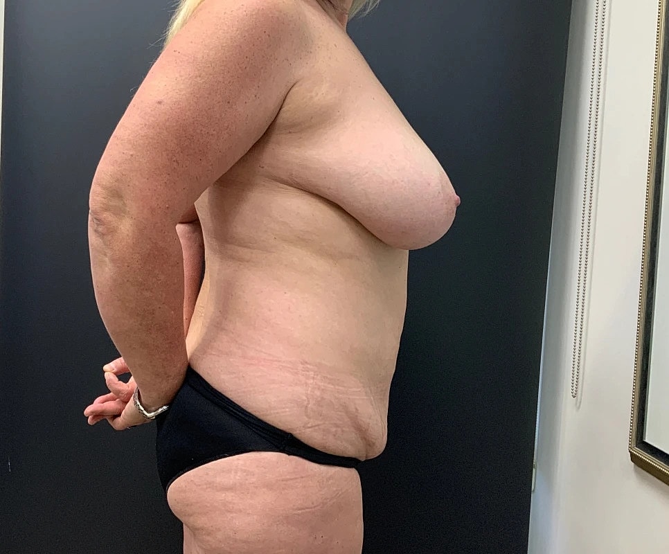 Breast Reduction Before & After