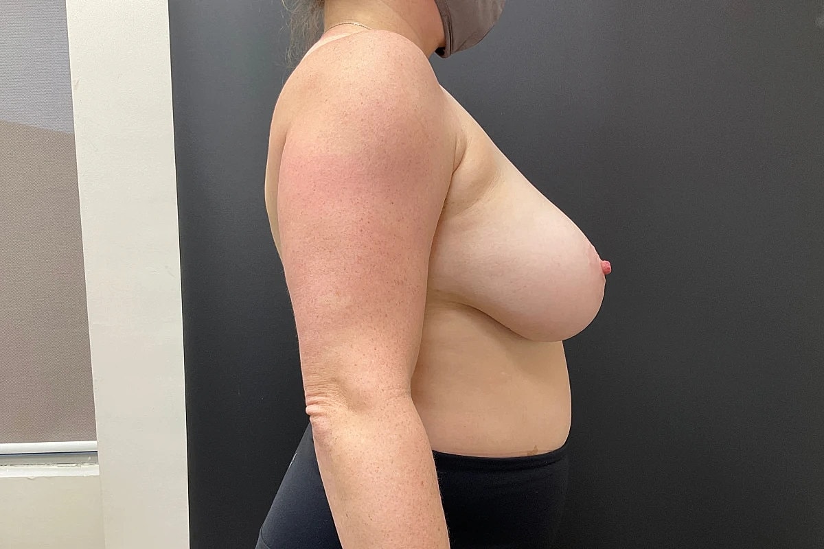 Breast Reduction Before & After