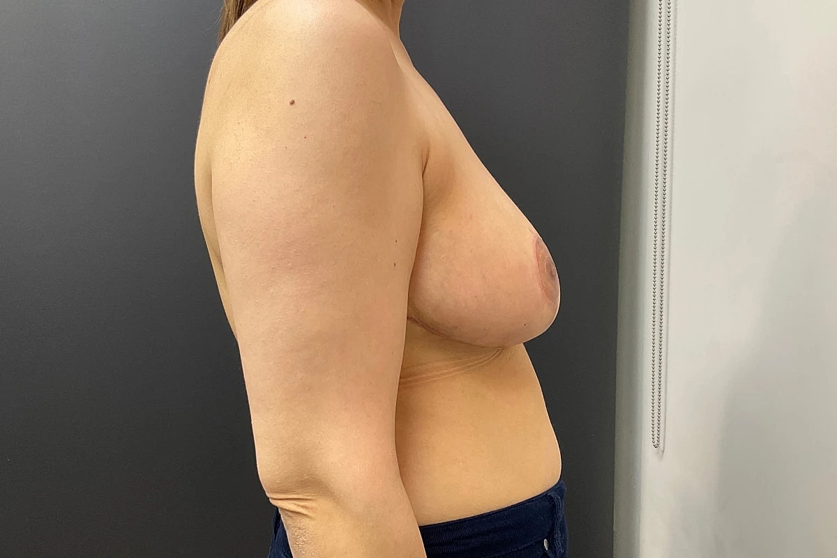Breast Reduction Before & After