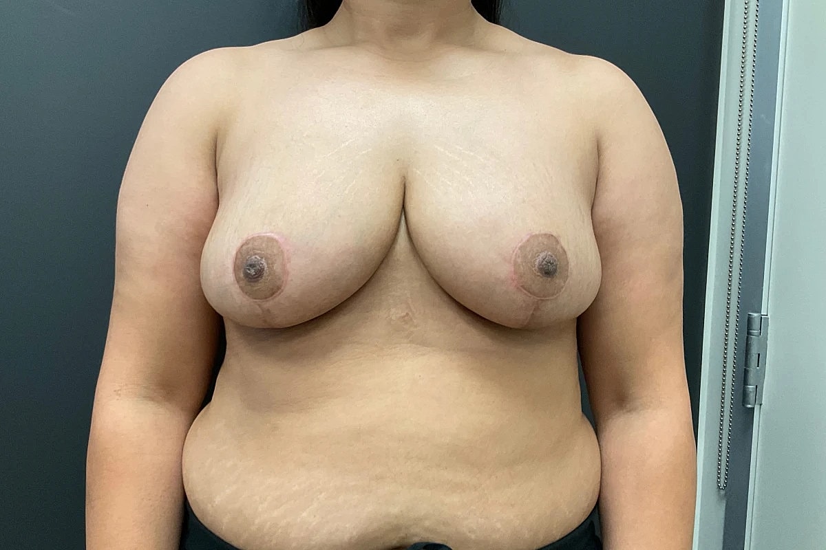 Breast Reduction Before & After