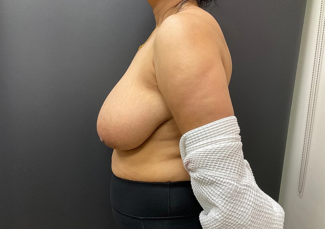 Breast Reduction Before & After