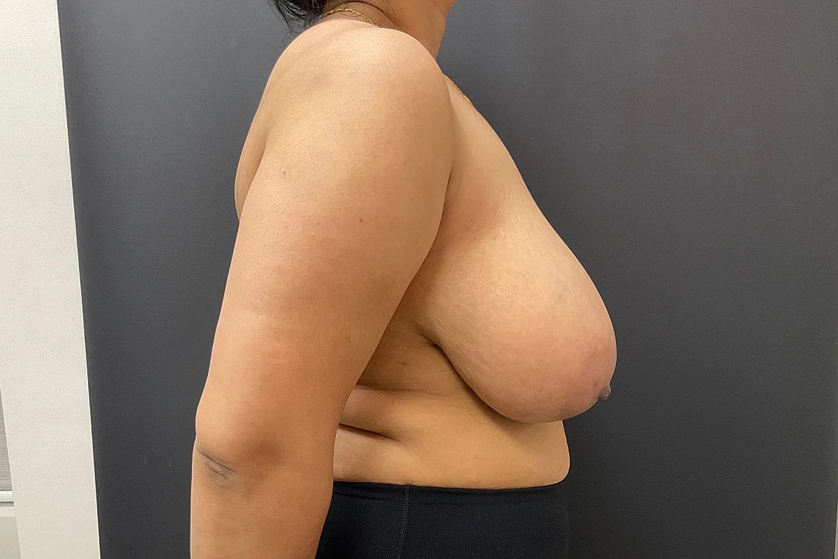 Breast Reduction Before & After