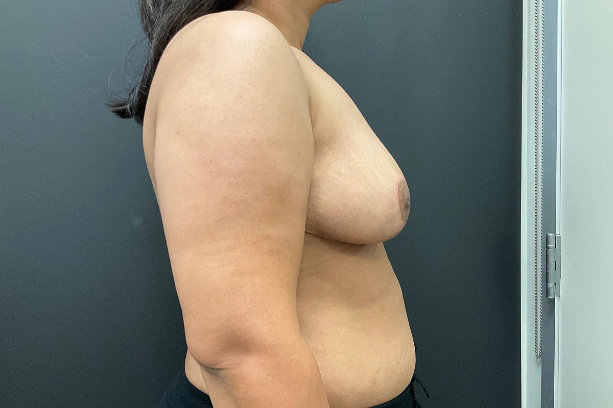 Breast Reduction Before & After