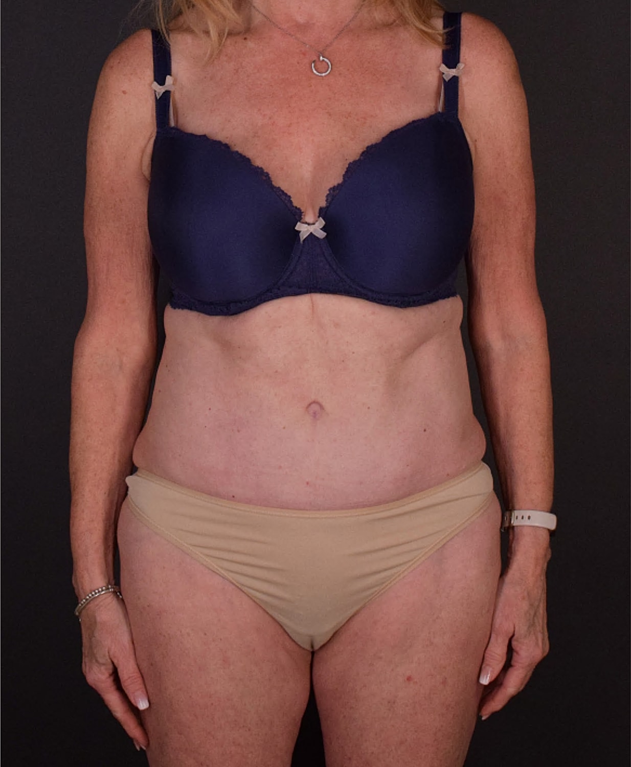 Mommy Makeover Before & After