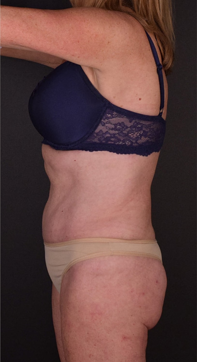 Mommy Makeover Before & After