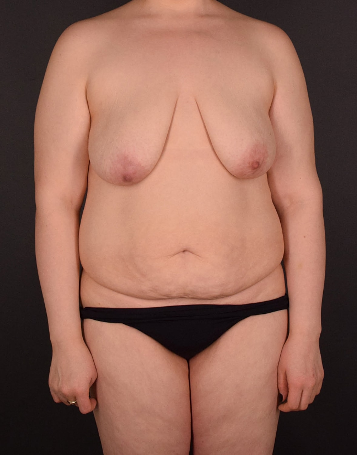 Mommy Makeover Before & After