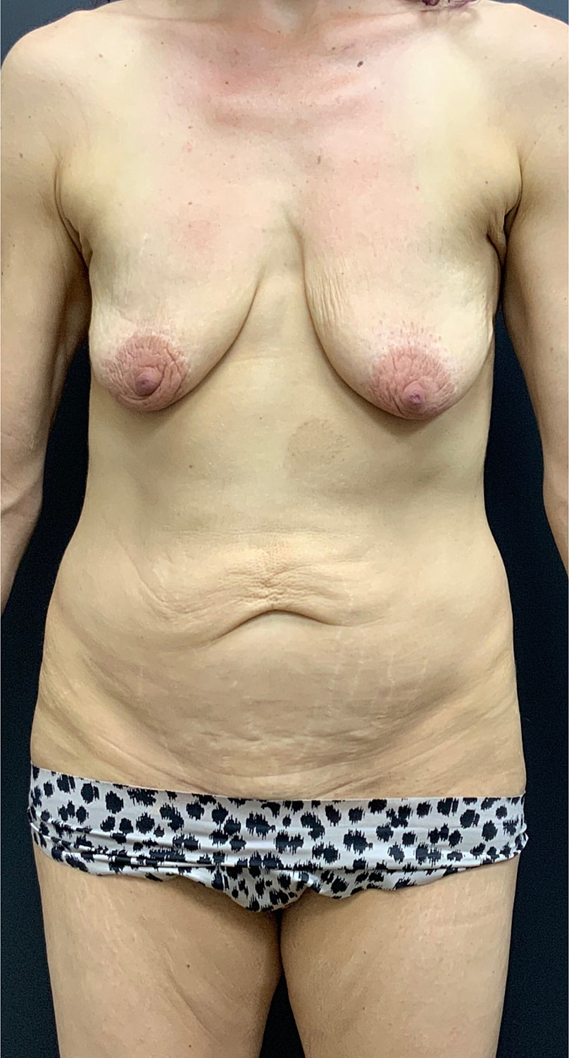 Mommy Makeover Before & After