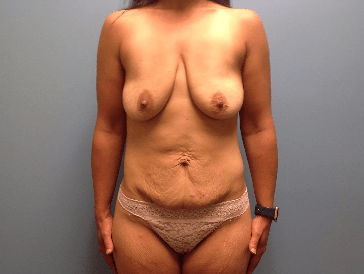 Mommy Makeover Before & After