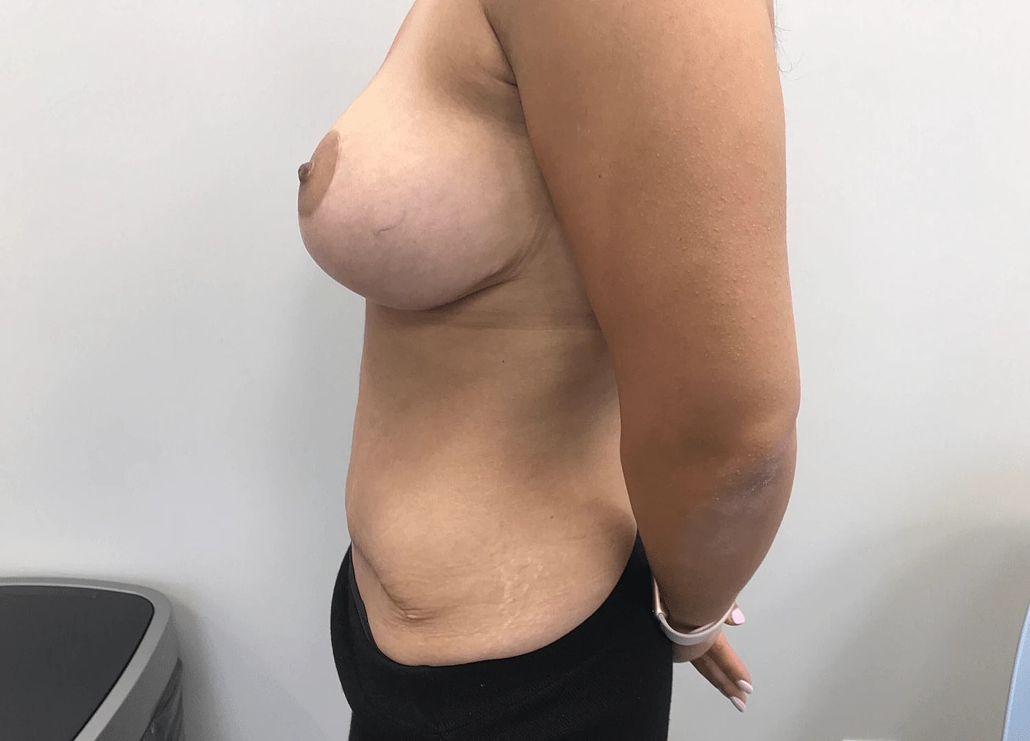 Mommy Makeover Before & After