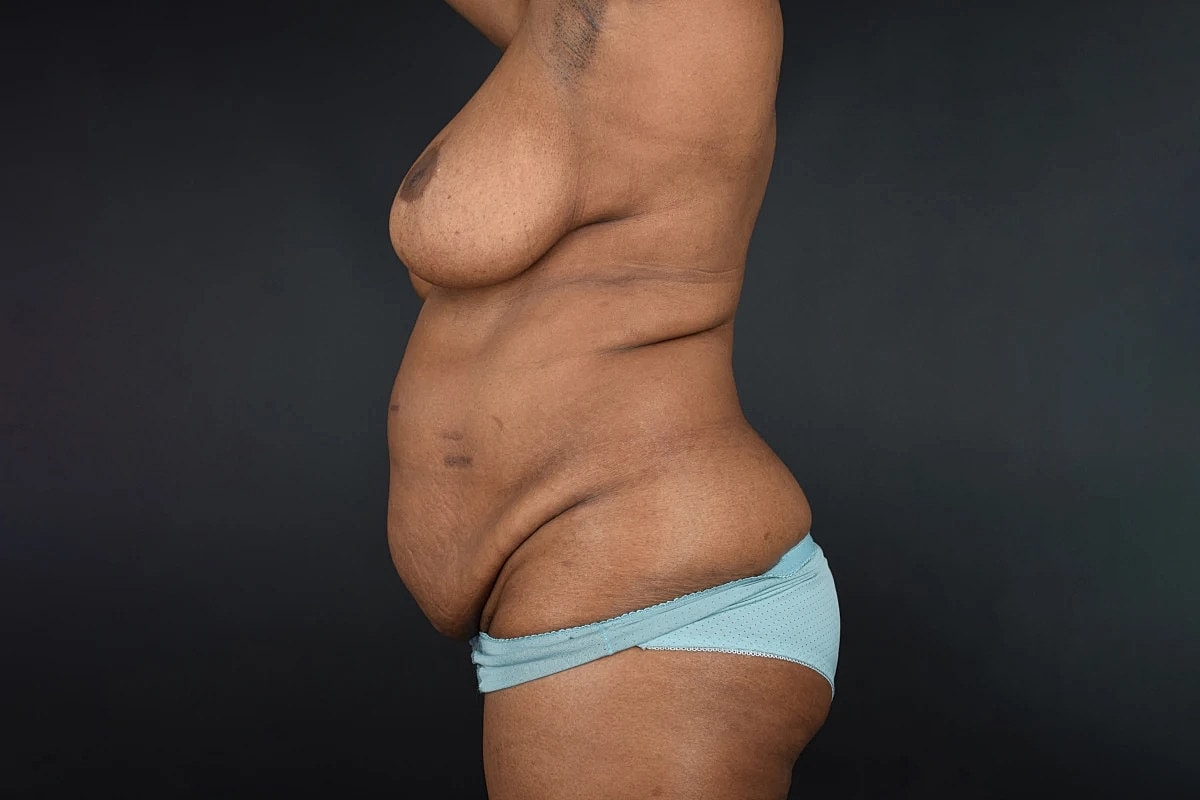 Mommy Makeover Before & After
