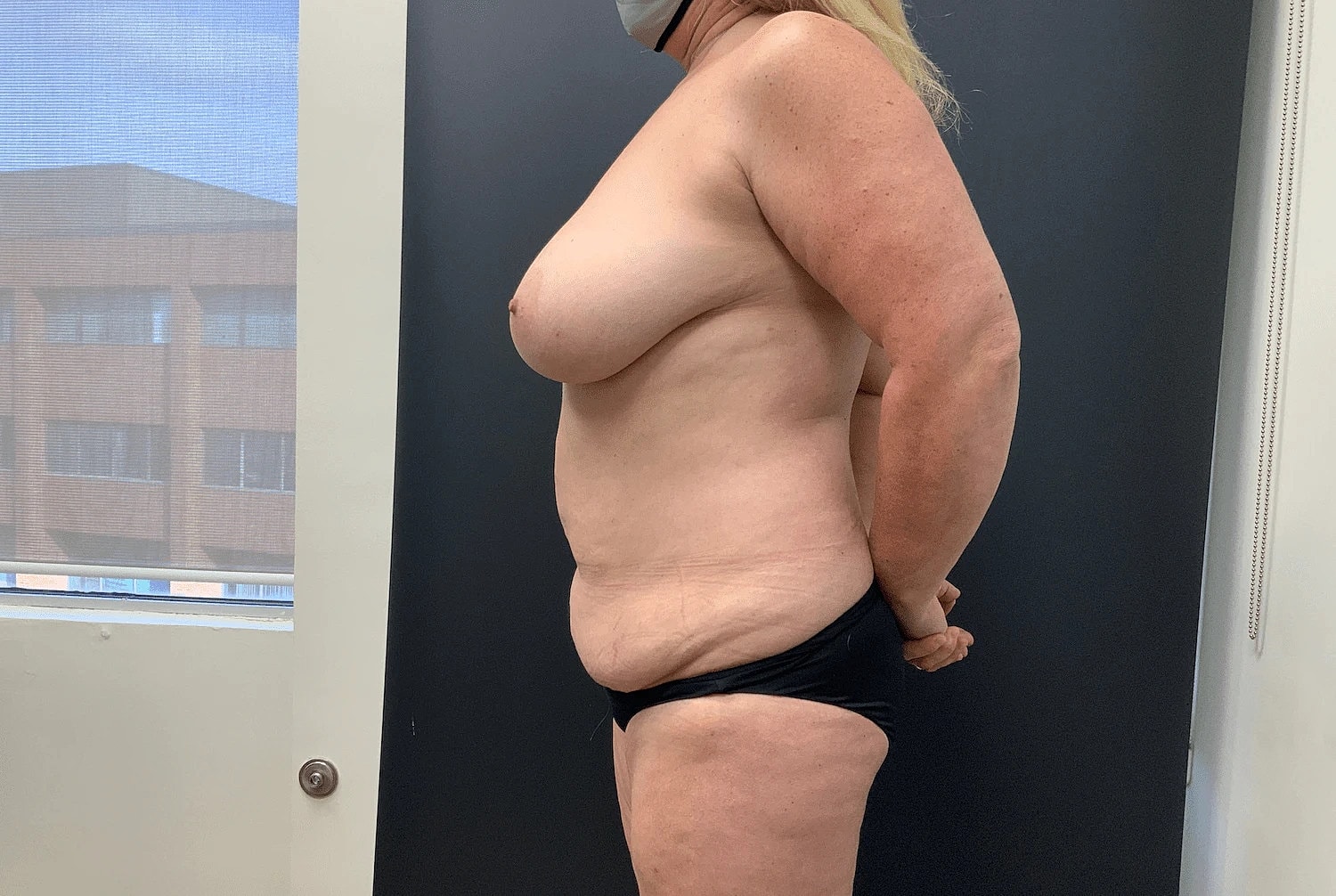 Mommy Makeover Before & After