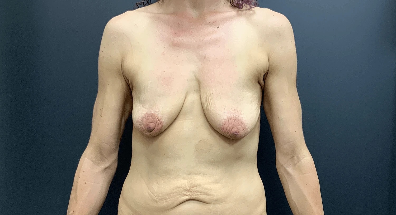 Breast Augmentation Lift Before & After