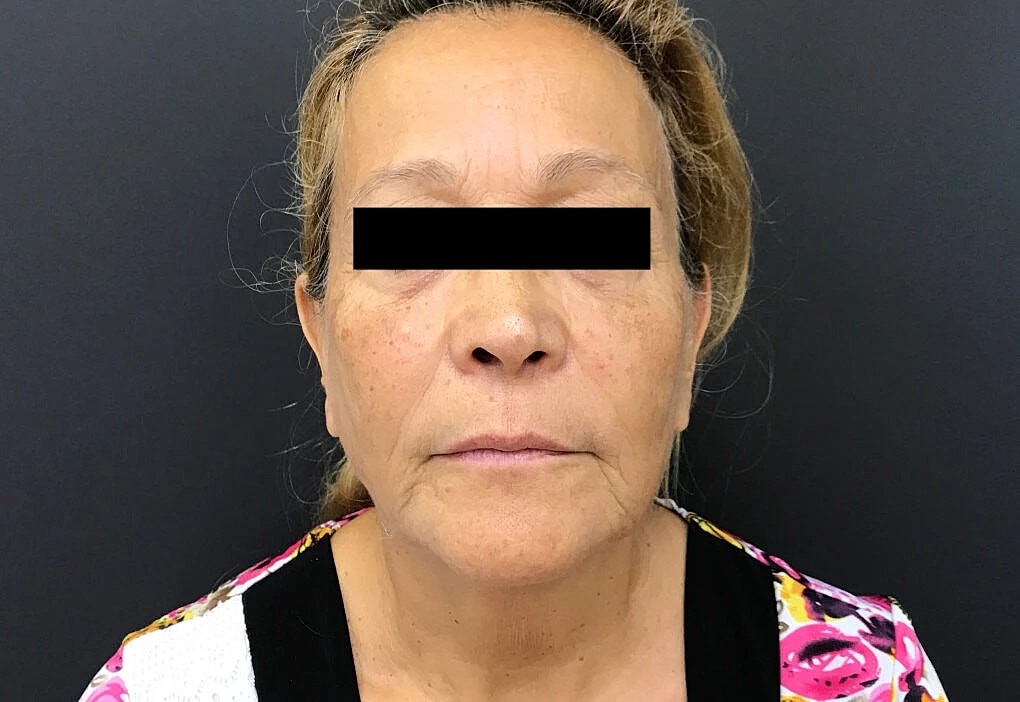 Venus Tribella Before & After