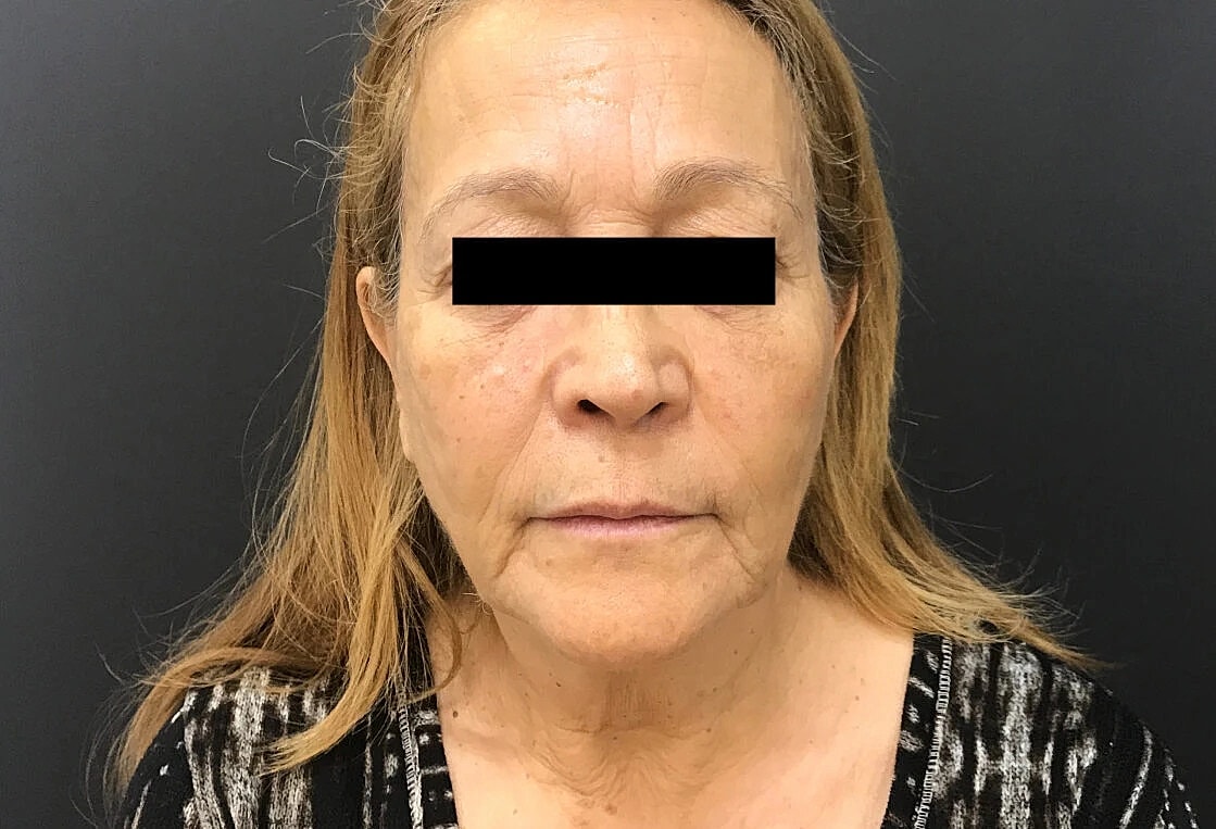 Venus Tribella Before & After