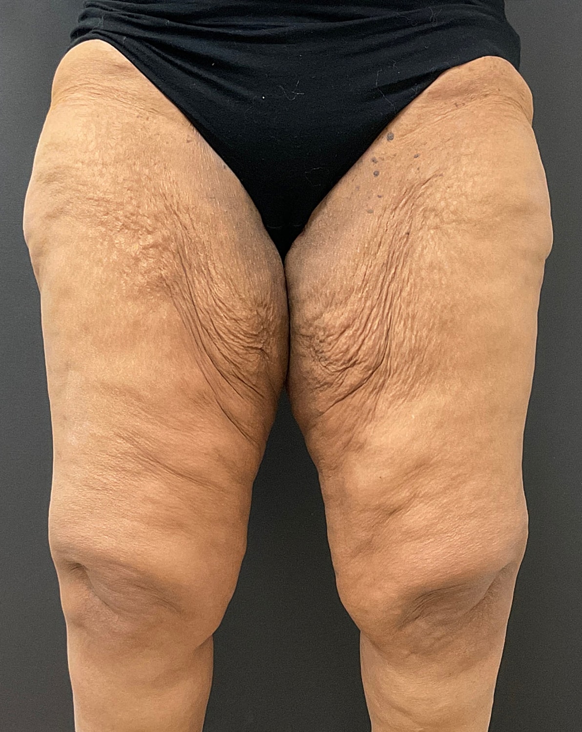 Arm Lift Thigh Lift Before & After