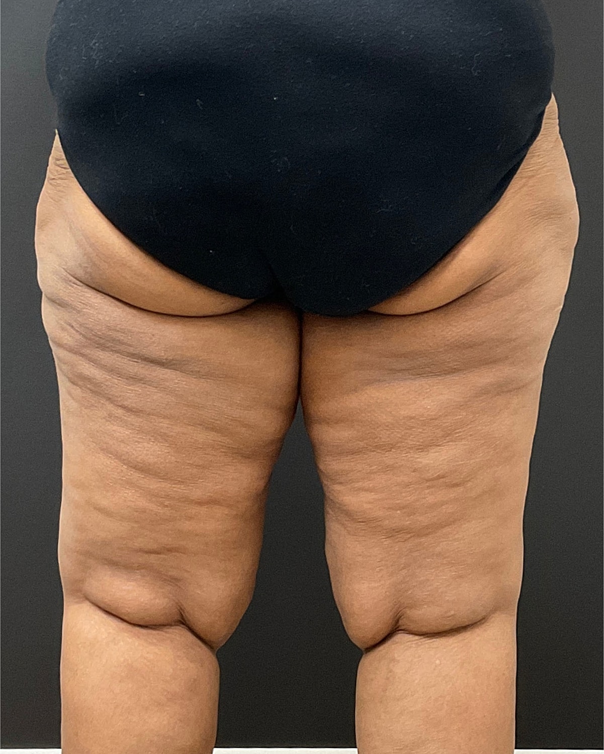 Arm Lift Thigh Lift Before & After