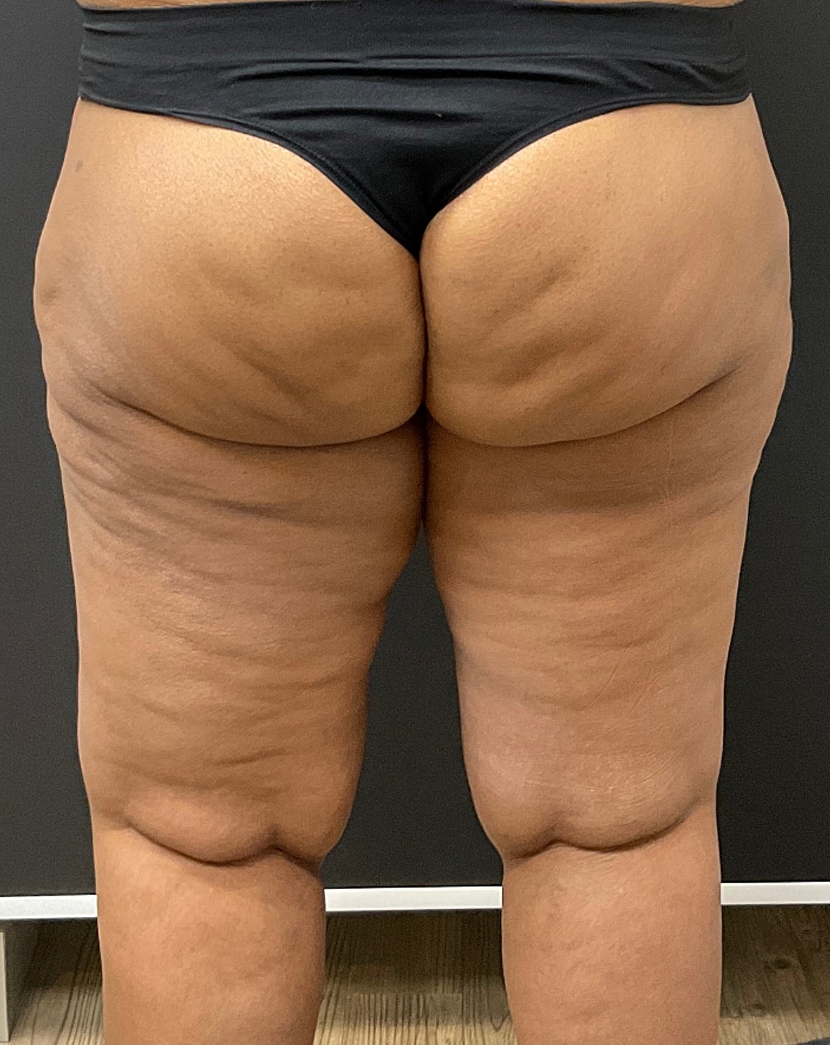 Arm Lift Thigh Lift Before & After