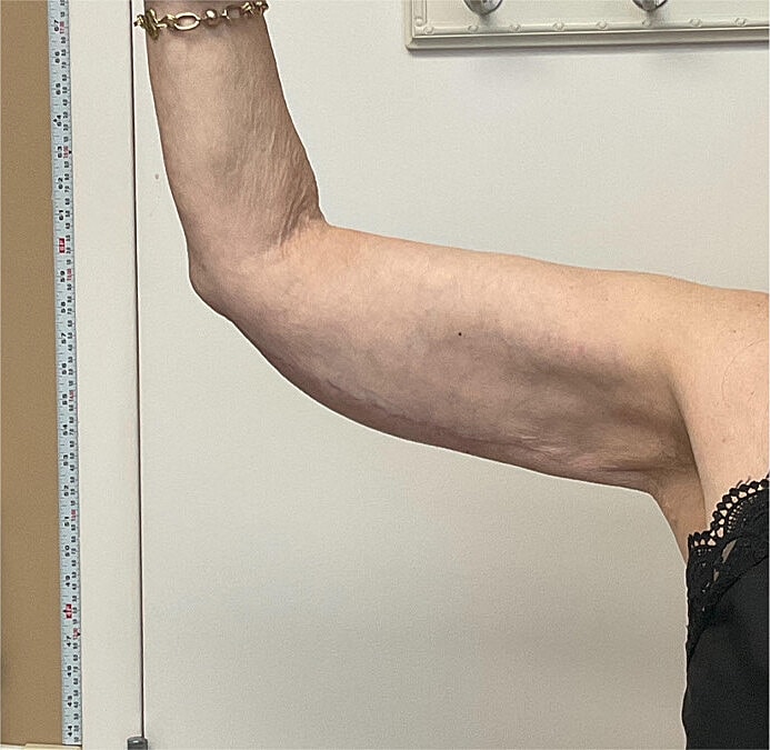 Arm Lift Thigh Lift Before & After
