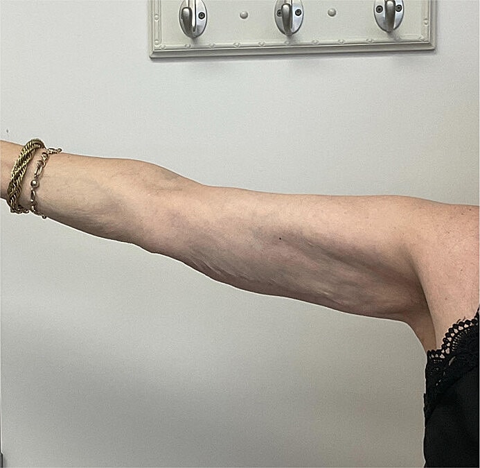Arm Lift Thigh Lift Before & After
