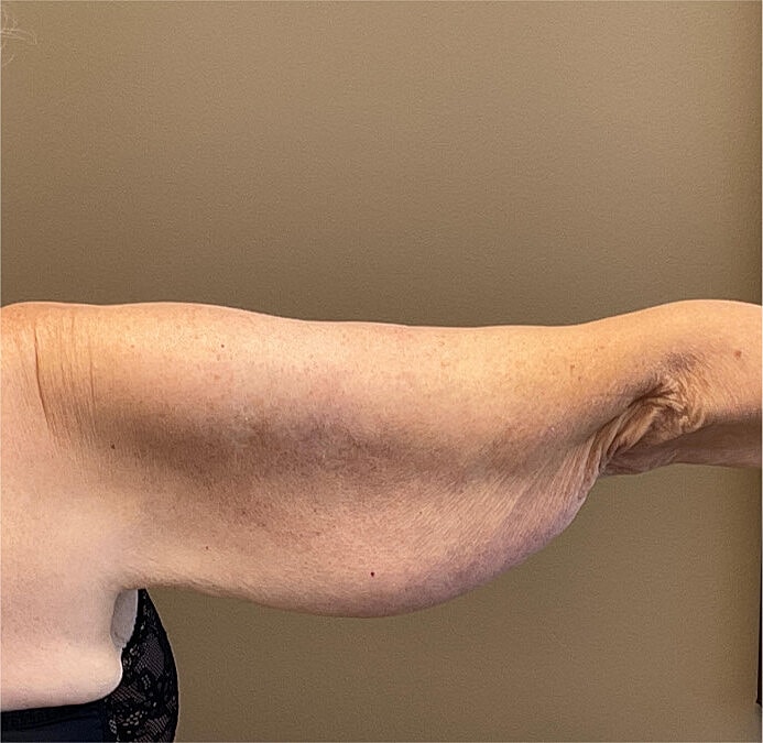 Arm Lift Thigh Lift Before & After
