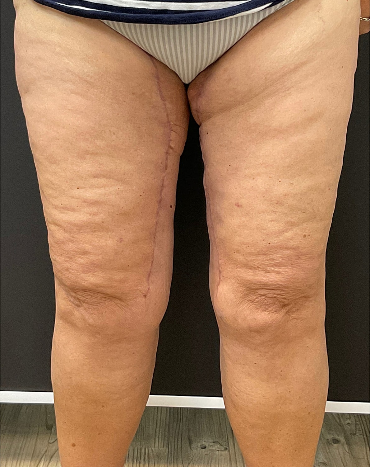 Arm Lift Thigh Lift Before & After