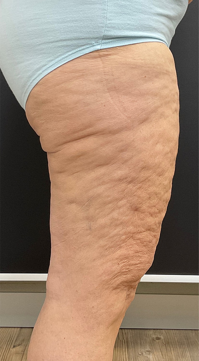 Arm Lift Thigh Lift Before & After