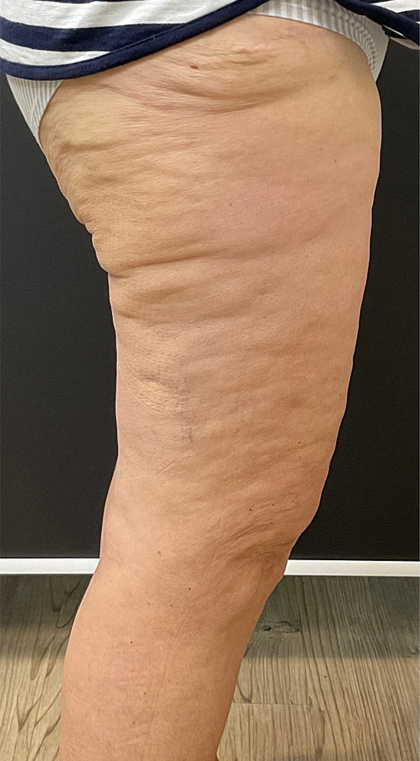 Arm Lift Thigh Lift Before & After