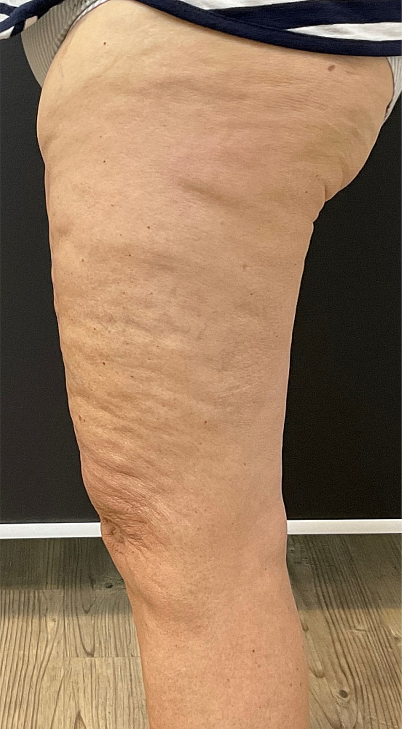 Arm Lift Thigh Lift Before & After