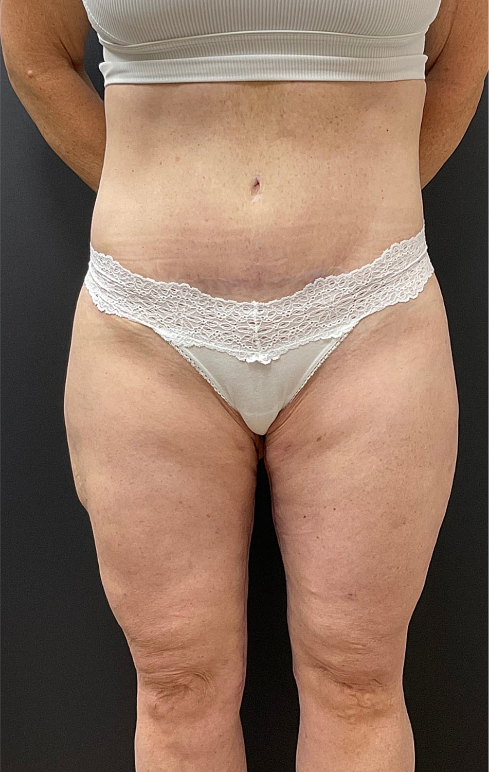 Arm Lift Thigh Lift Before & After