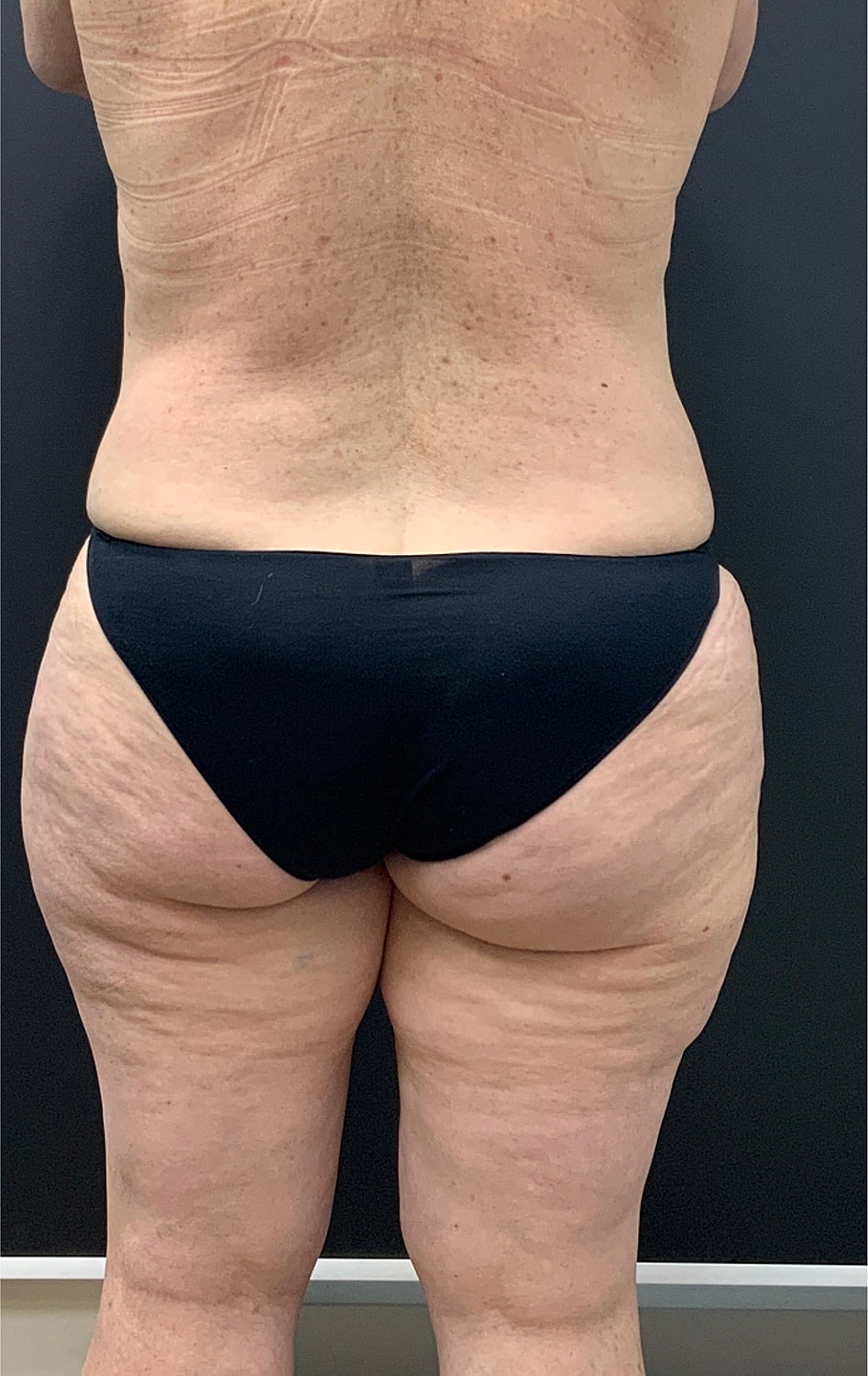 Arm Lift Thigh Lift Before & After