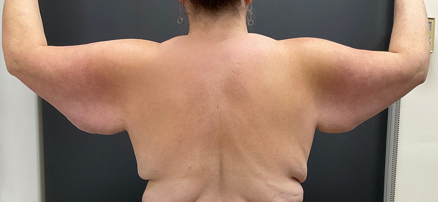 Arm Lift Thigh Lift Before & After