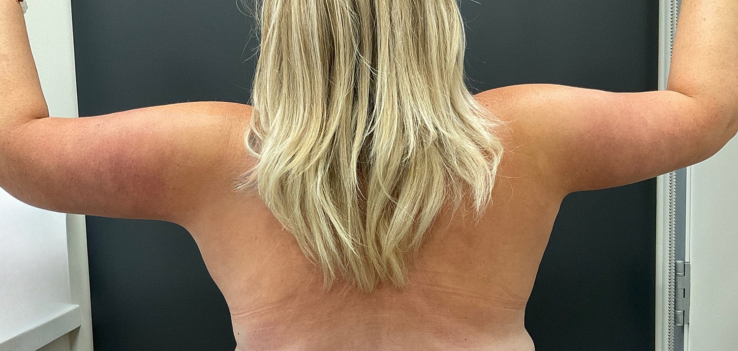 Arm Lift Thigh Lift Before & After
