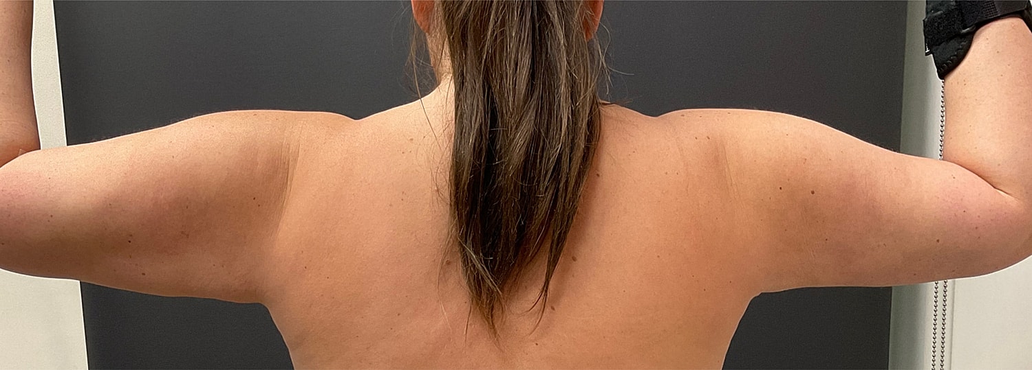 Arm Lift Thigh Lift Before & After