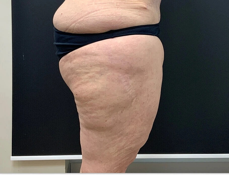 Side view of thigh with visible skin texture.