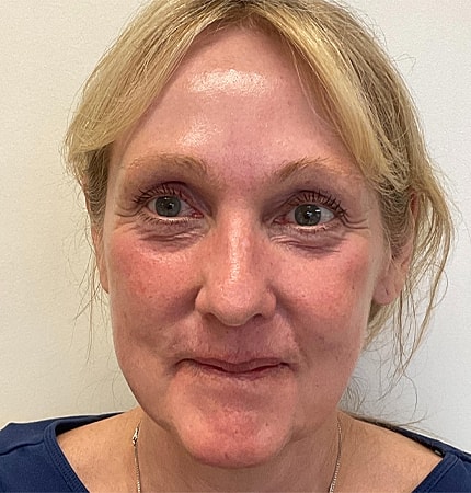 Phenol Peel Before & After