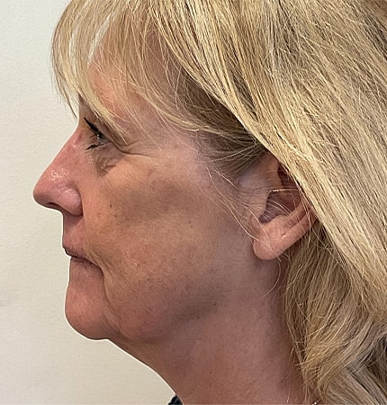 Phenol Peel Before & After