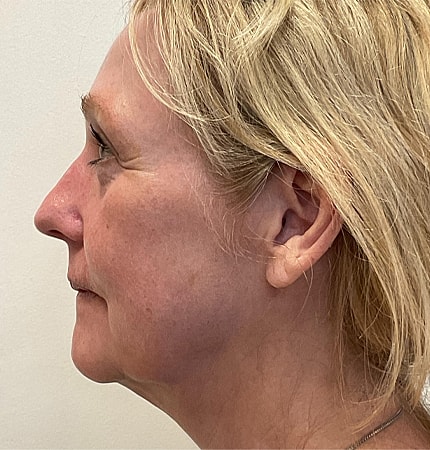 Phenol Peel Before & After