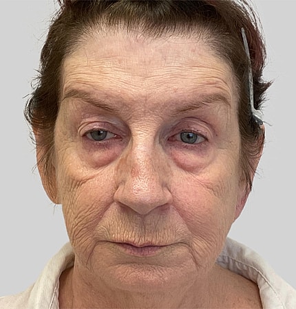 Phenol Peel Before & After