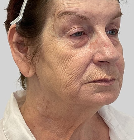 Phenol Peel Before & After