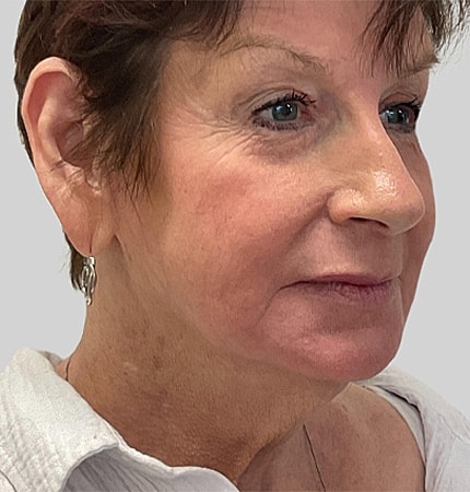 Phenol Peel Before & After