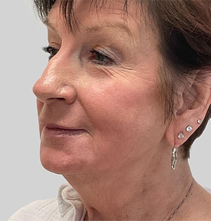 Phenol Peel Before & After