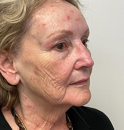 Phenol Peel Before & After