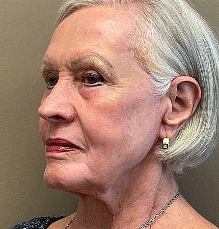 Phenol Peel Before & After