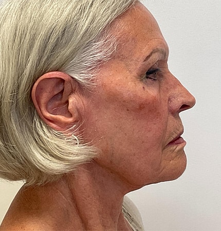 Phenol Peel Before & After