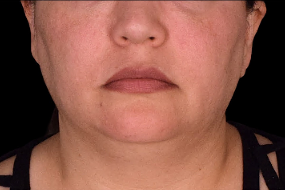 Facelift Neck Lift Before & After