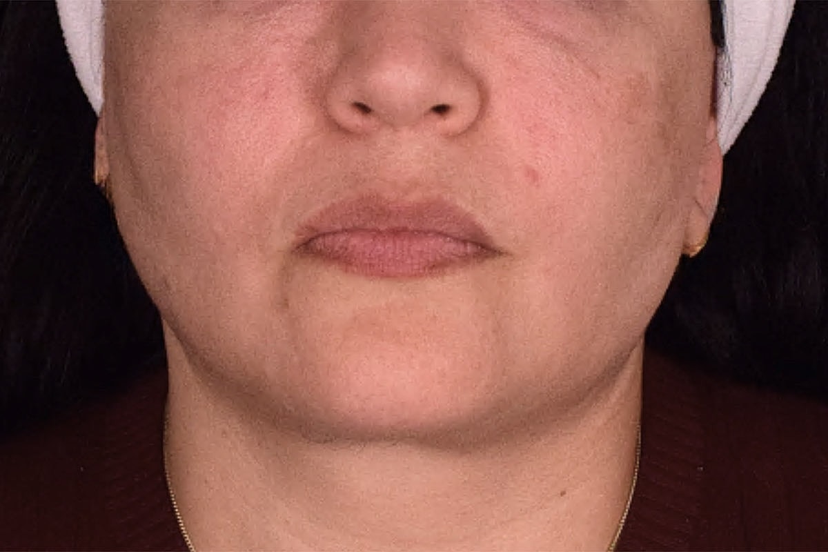 Facelift Neck Lift Before & After