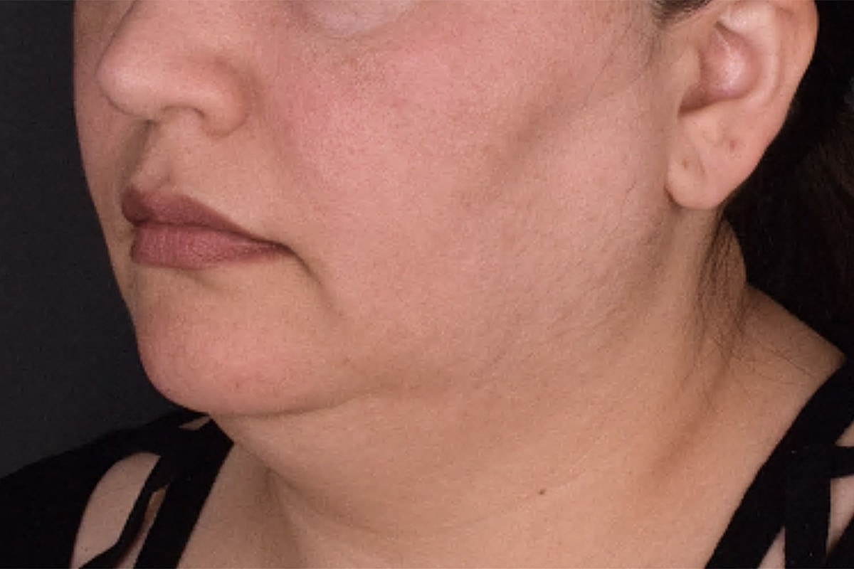 Facelift Neck Lift Before & After