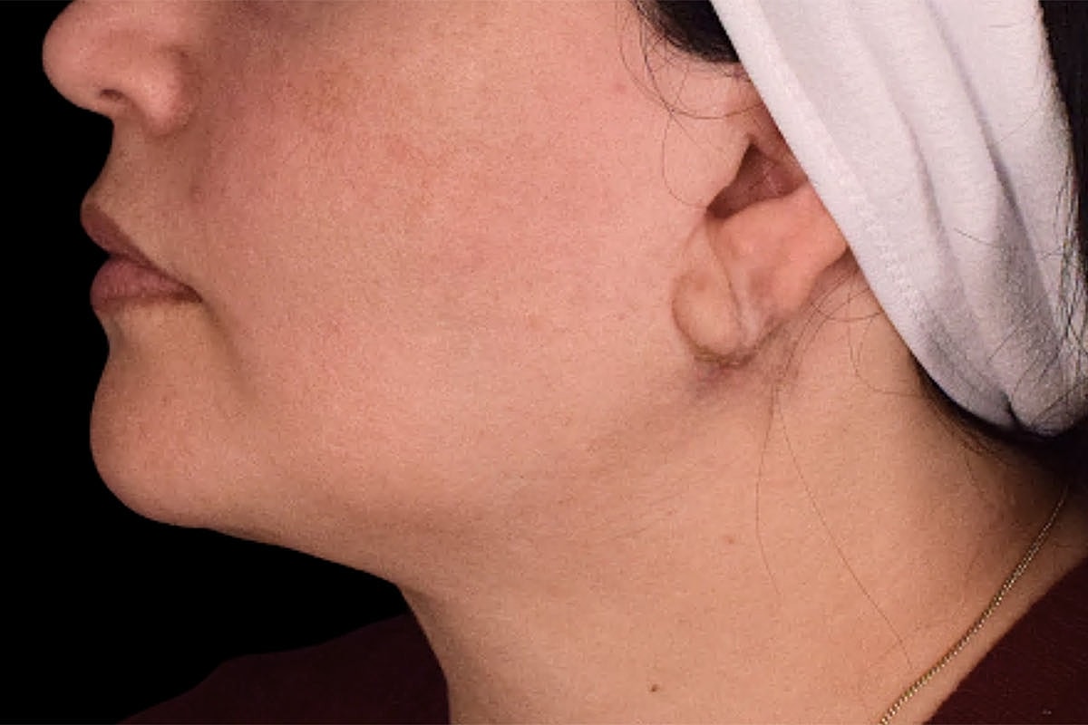 Facelift Neck Lift Before & After