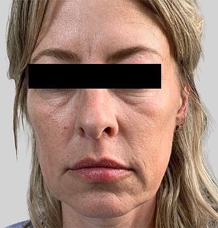 Facelift Neck Lift Before & After